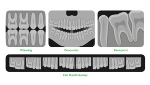 A graphic with various x-rays of teeth